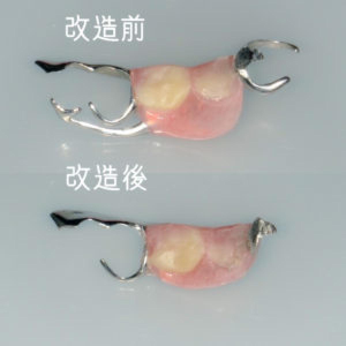 嚙めない入れ歯