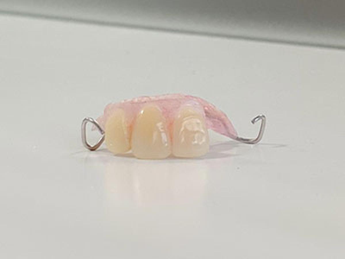 前歯がグラグラで、インプラントを勧められた患者さん(40代女性)