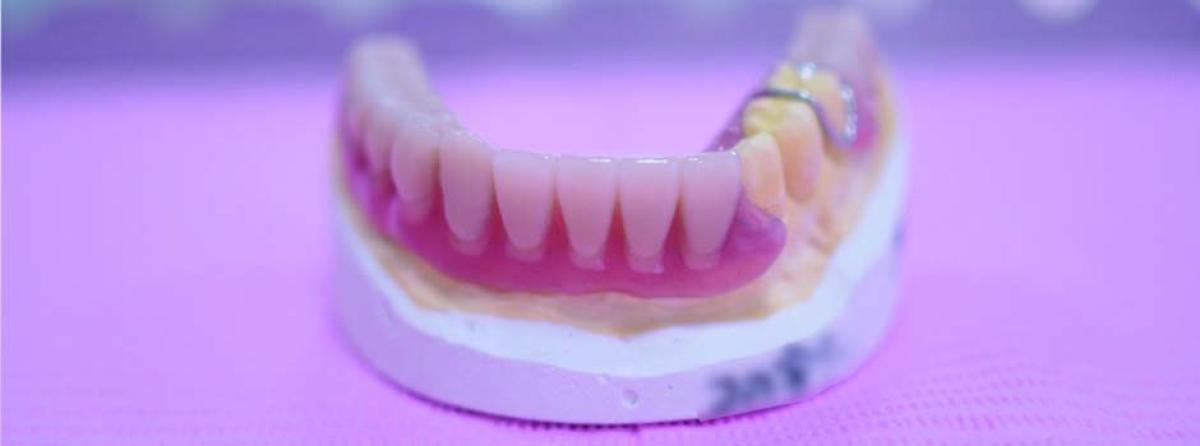 入れ歯は消耗品?