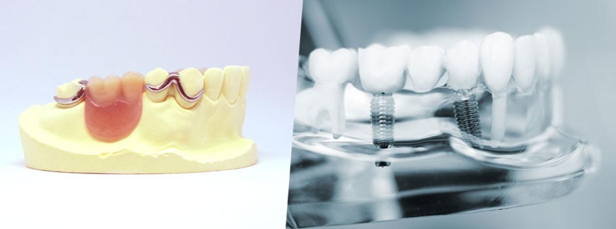 あなたに合うのはインプラント?入れ歯?
